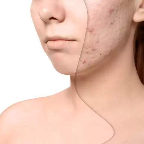 DAY CREAM - ACNE PRONE