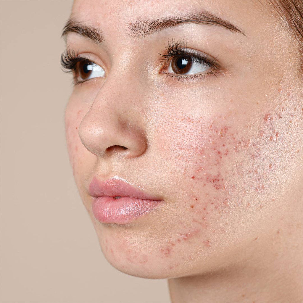 DAY CREAM - ACNE PRONE